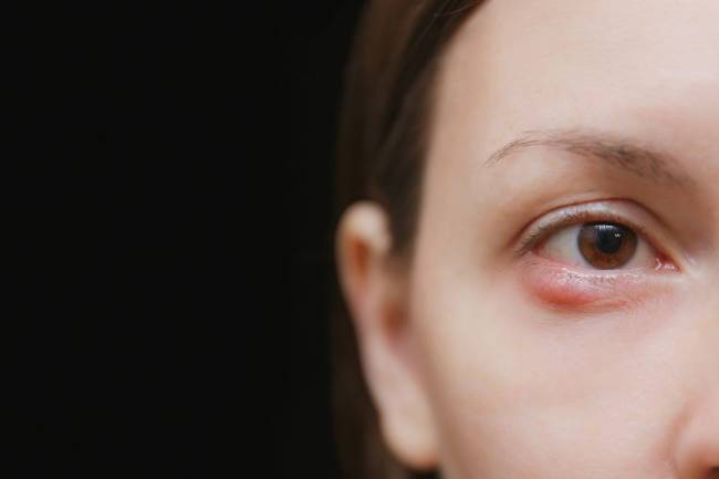 Del mito al cuidado real: Lo que los especialistas recomiendan frente a los orzuelos