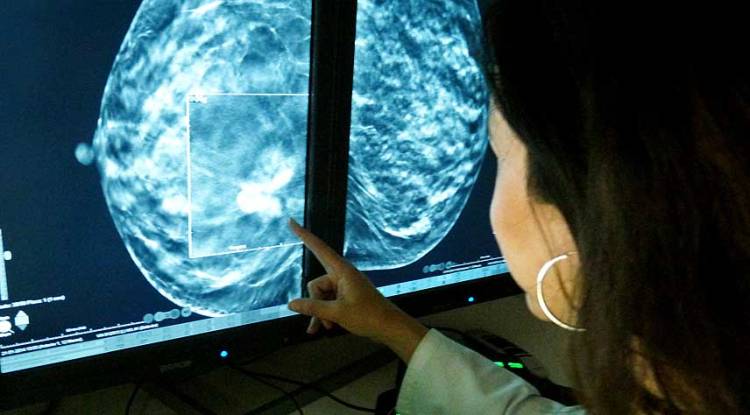 Revelan un nuevo estudio que mejora la detección del cáncer de mama