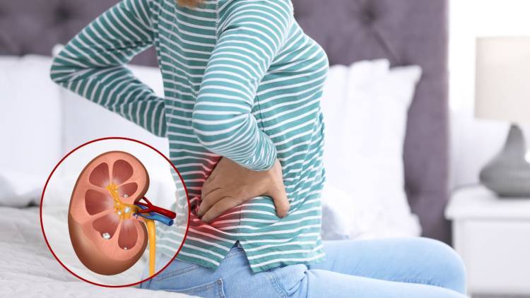 Un paso hacia el futuro: Bacterias modificadas logran reducir cálculos renales